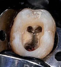 root-canal
